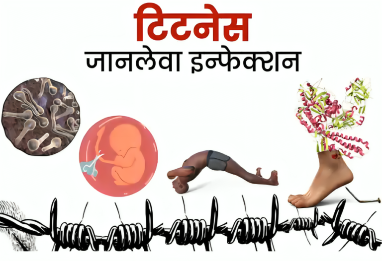 टिटनैस (Tetanus) का होम्योपैथिक इलाज और दवाएं